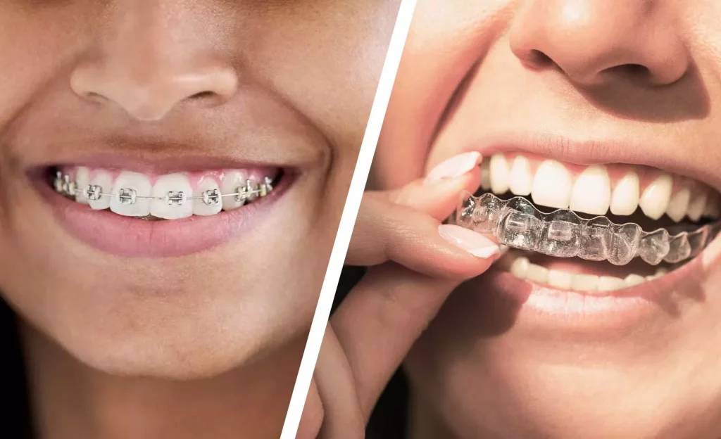 Invisalign vs. Traditional Braces