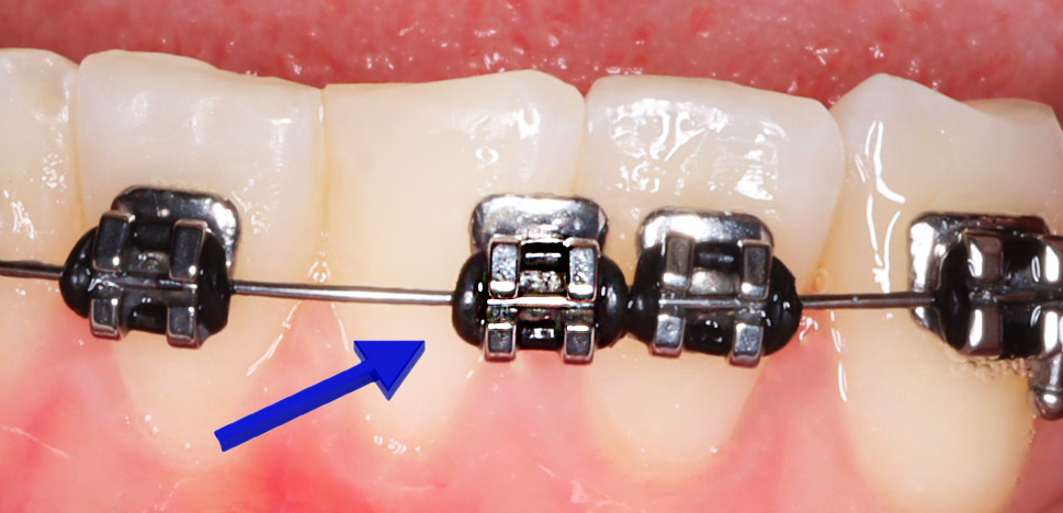 common mistakes when wearing braces: ignoring loose brackets