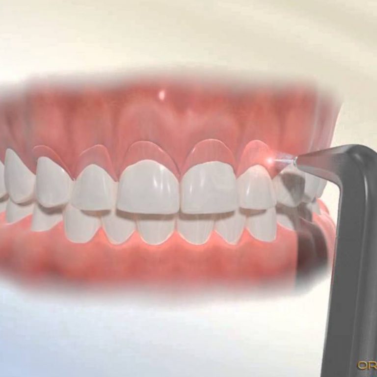 Gummy Smile Correction