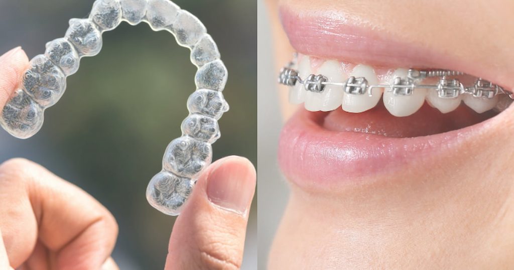 a photo showing the difference between clear braces and traditional braces