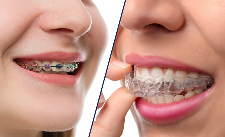 a photo showing the difference between clear braces and traditional braces