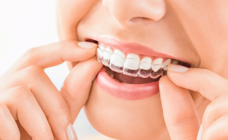 a photo showing how clear braces really look like and how it's different from traditional braces