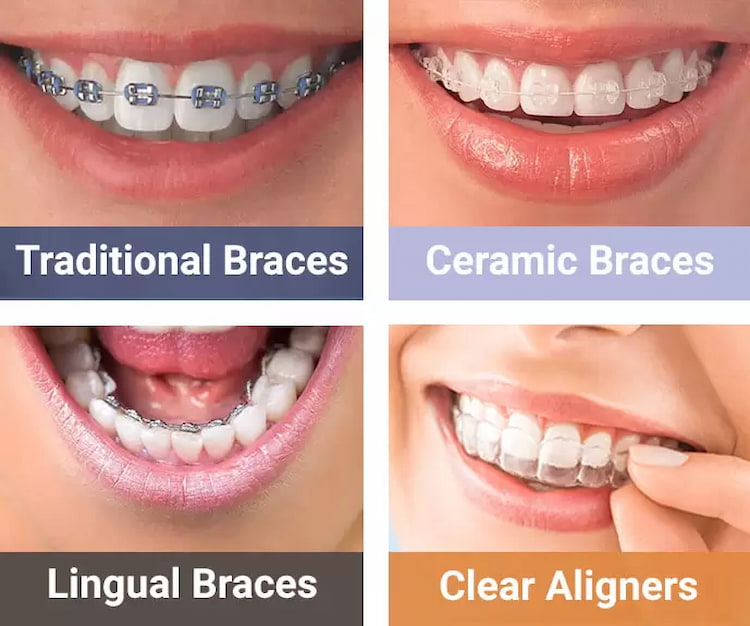 a photo showing the difference between clear braces, traditional braces, clear aligners and ceramic braces