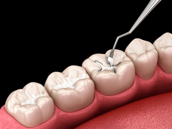 Composite dental filling