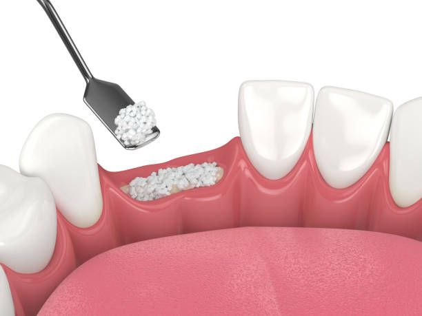 3D render of dental bone grafting with dental bone biomaterial over white background. Jaw bone augmentation procedure concept.