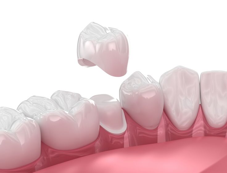Dental Crown