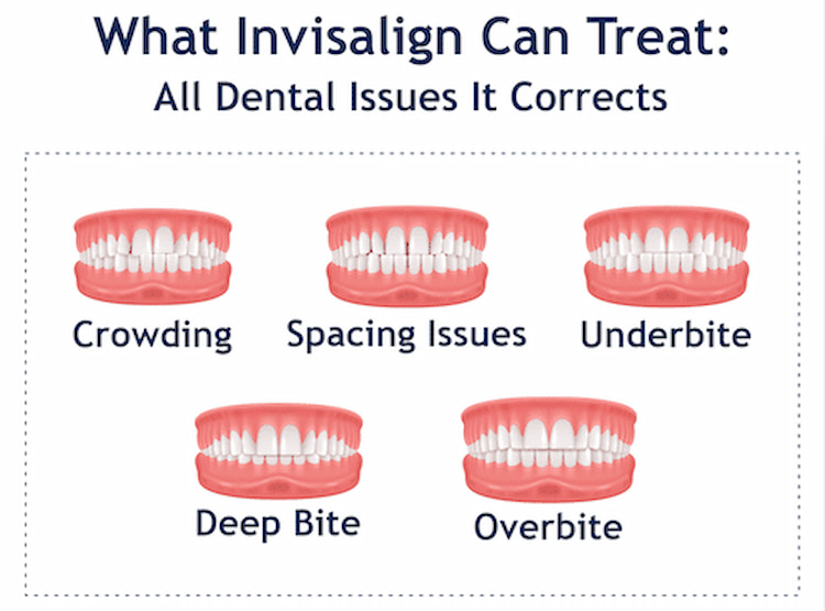 Common Dental Problems Invisalign Can Treat