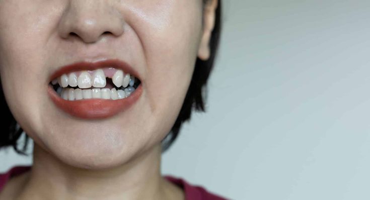 missing teeth