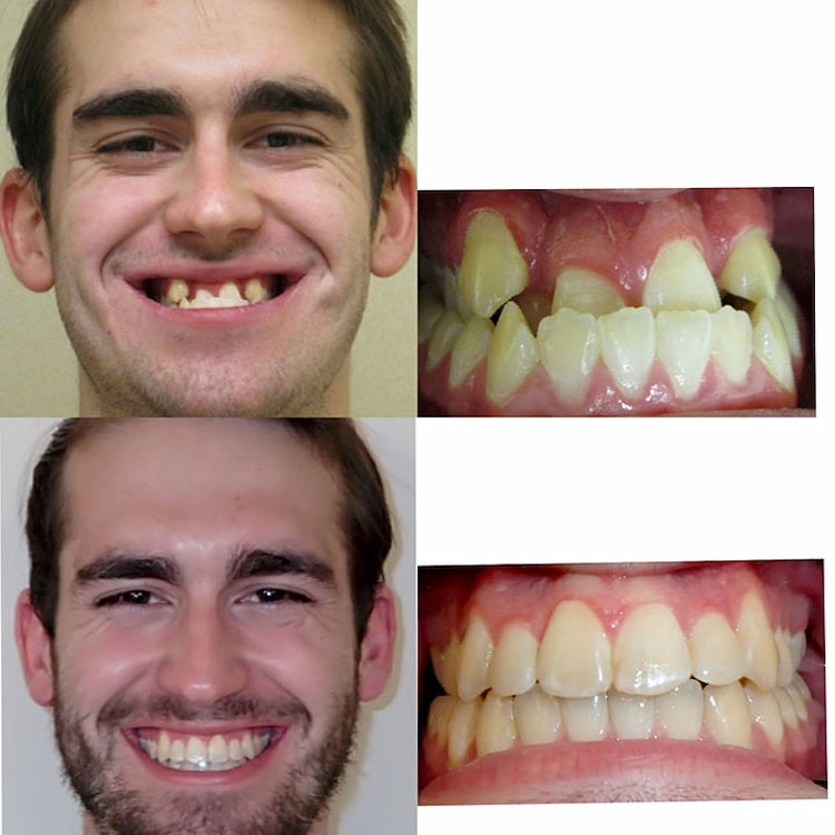 a photo showing a before and after result of orthodontic treatment 