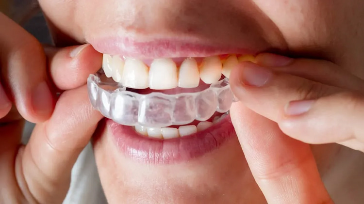 a woman wearing Invisalign