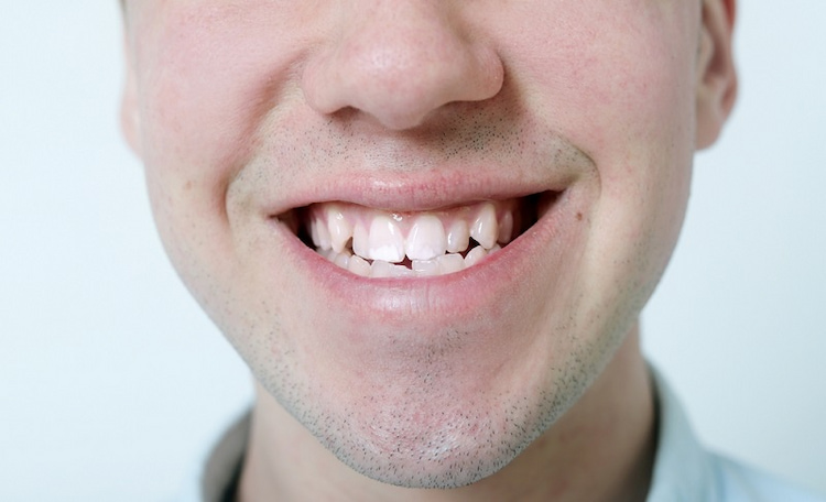a photo of a person with bite problems that can be fixed with orthodontic treatment 