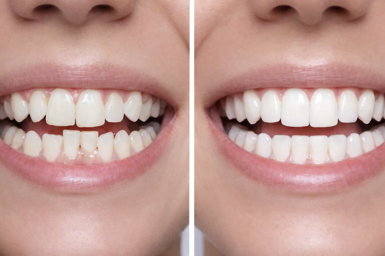 a before and after result of orthodontic treatment 