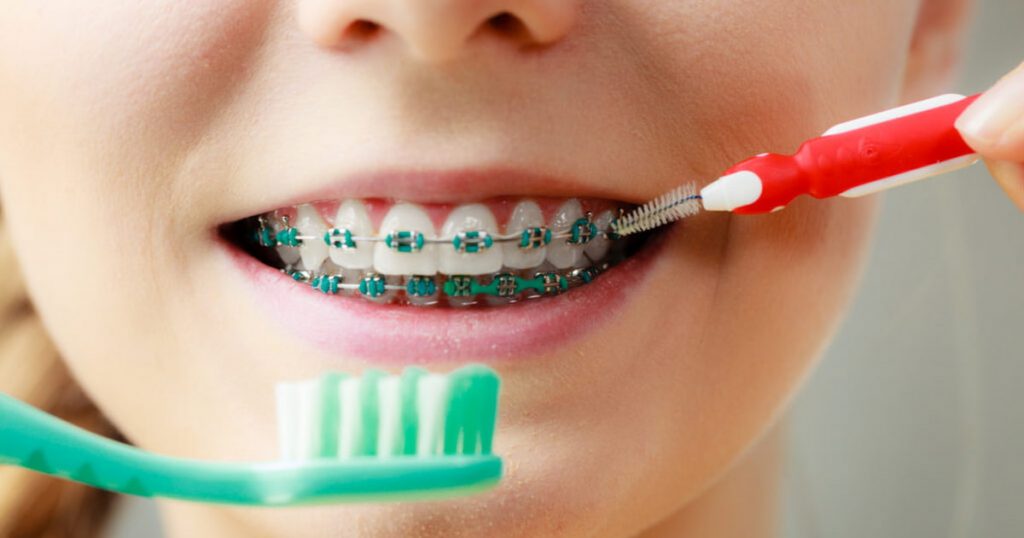 a photo of a young lady with braces showing how to keep your braces clean