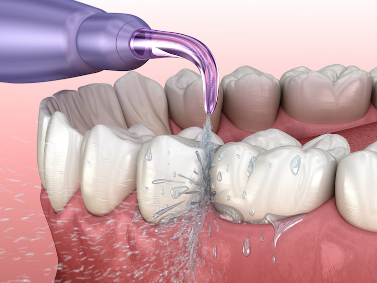 a photo showing a water flosser as a way to keep your braces clean