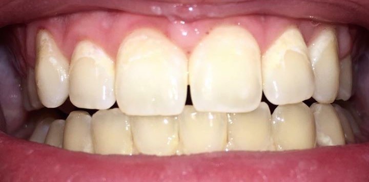 after dental cleaning