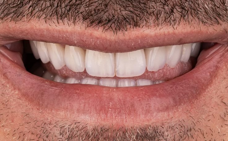 Whiter teeth after veneer