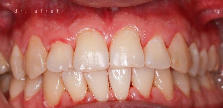 after dental cleaning