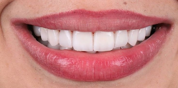 after veneer