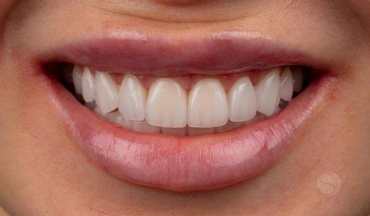straight tooth after veneer