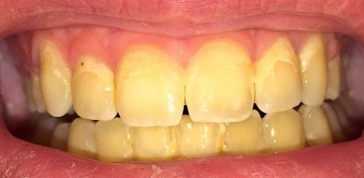 before dental cleaning