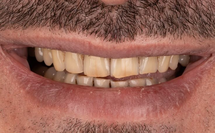 Yellow tooth before veneer