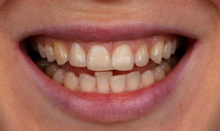 crooked tooth before veneer