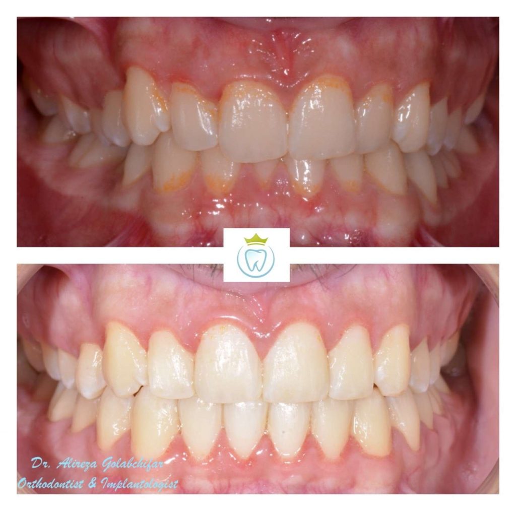 bite problem addressed with Invisalign treatment