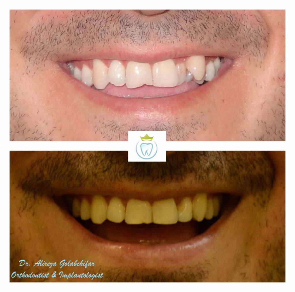 crowded teeth fixed with clear aligners