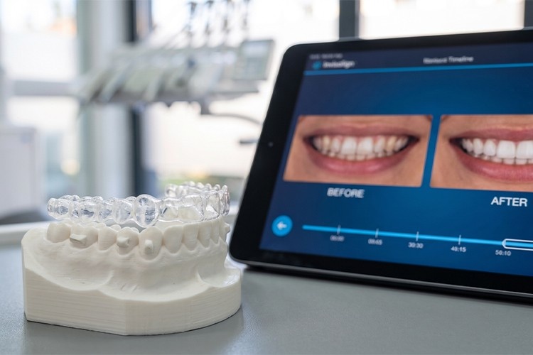 clear aligner next to a 3D dental model