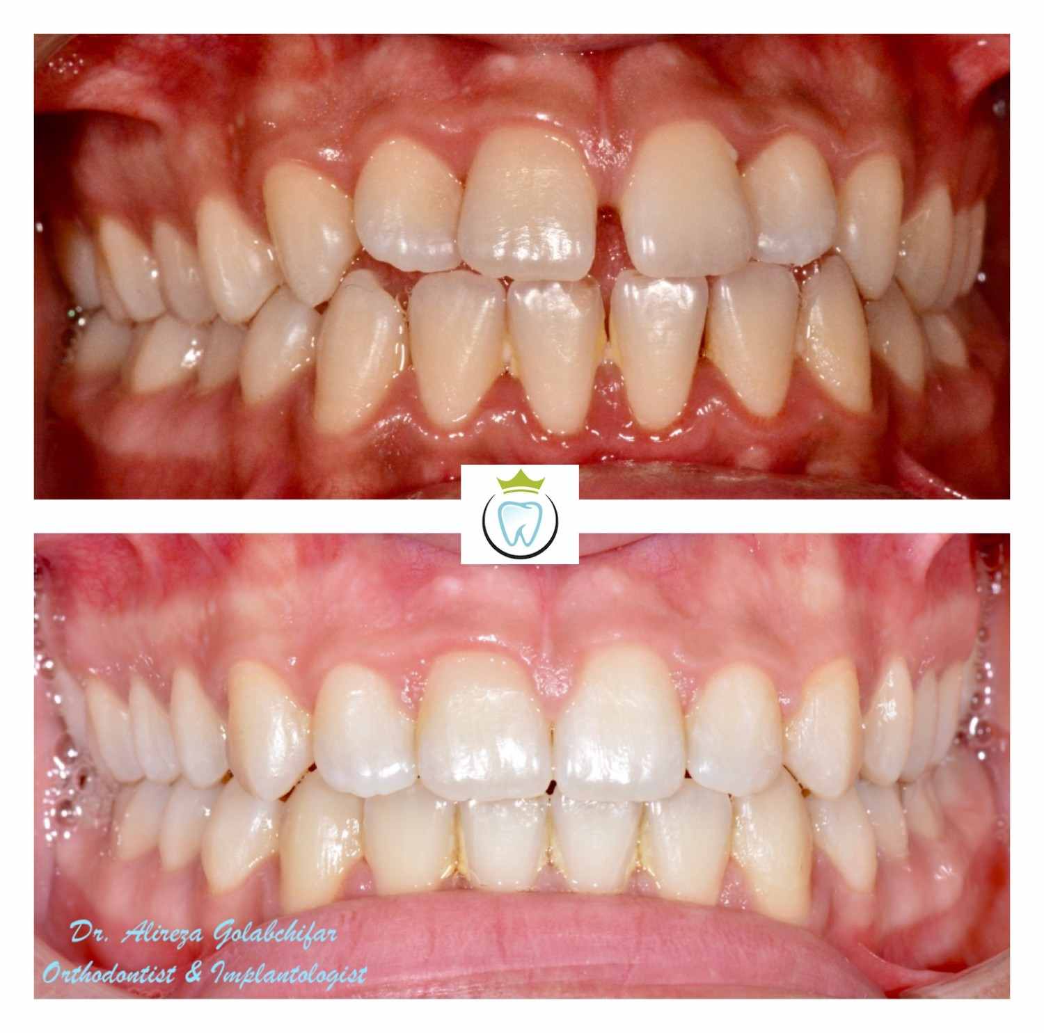 Gaps between teeth corrected with Invisalign treatment