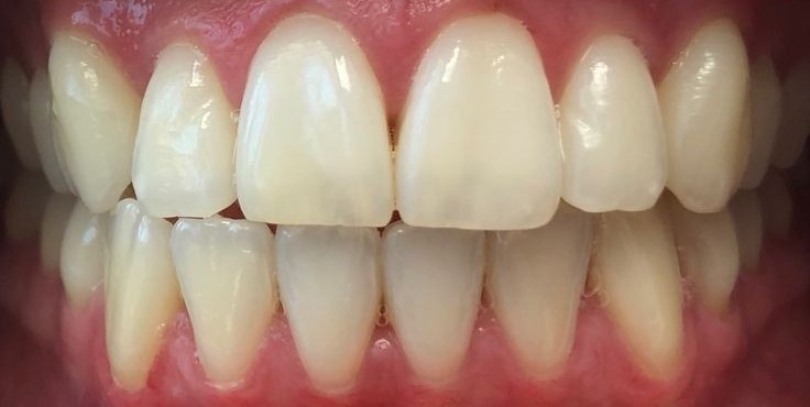 after whitening
