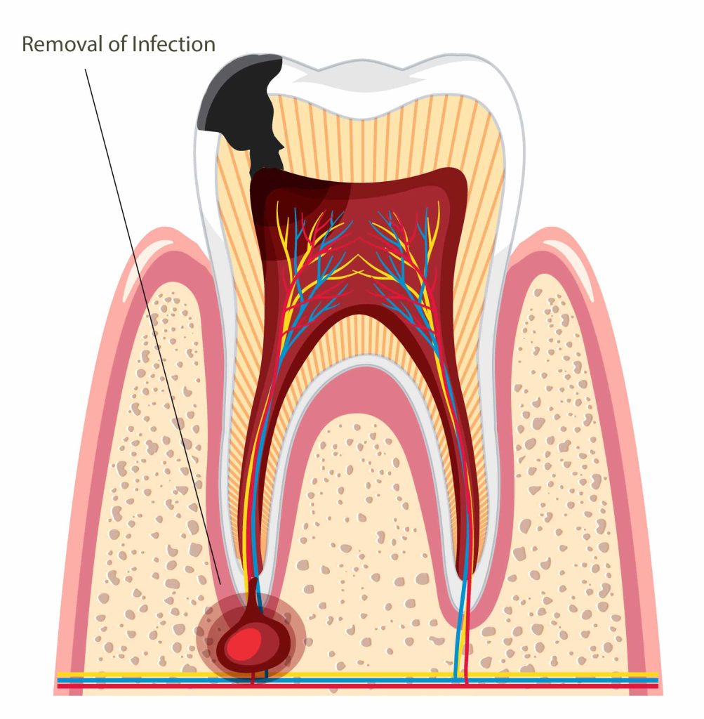 Apicoectomy removes tooth infection