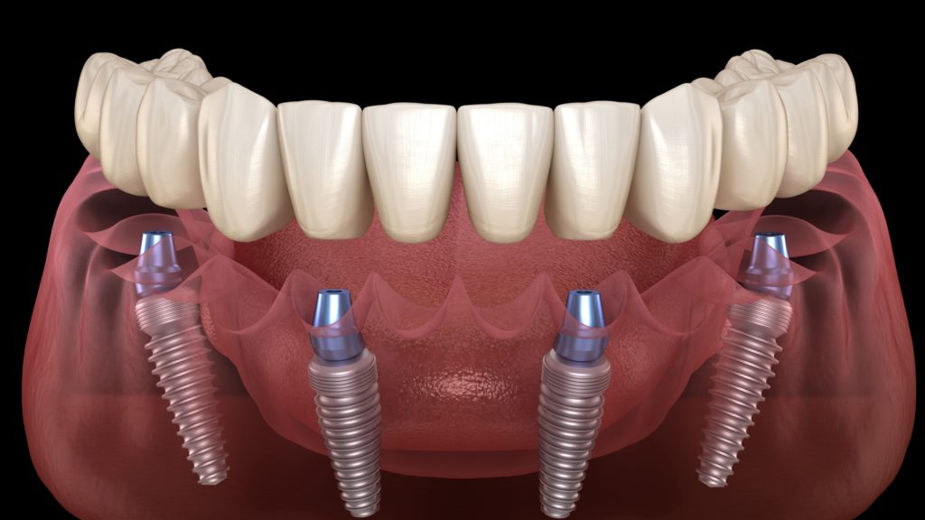 all-on-4 dental implant