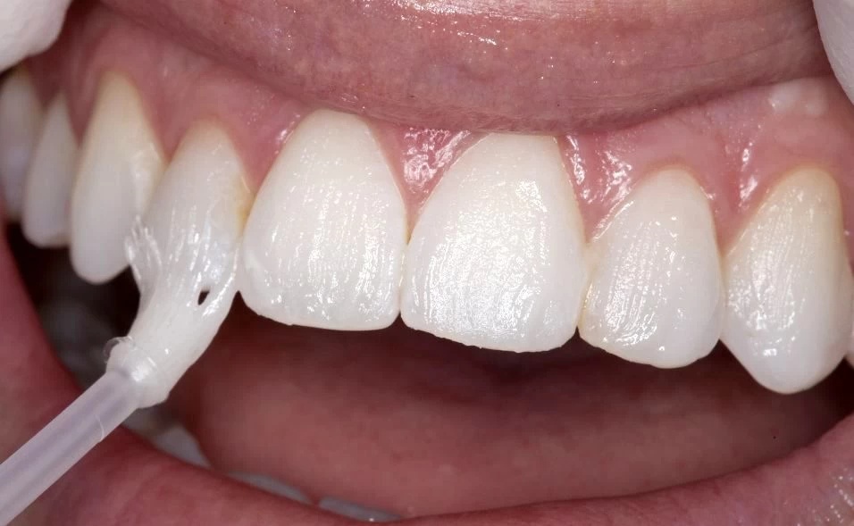 fluoride treatment