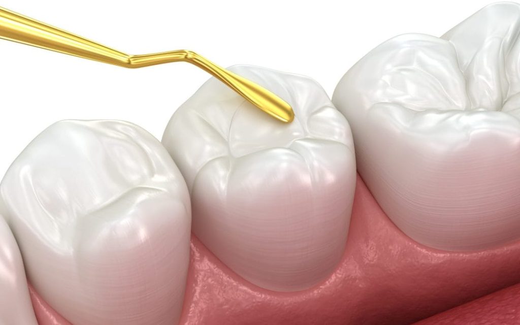 Dental sealant