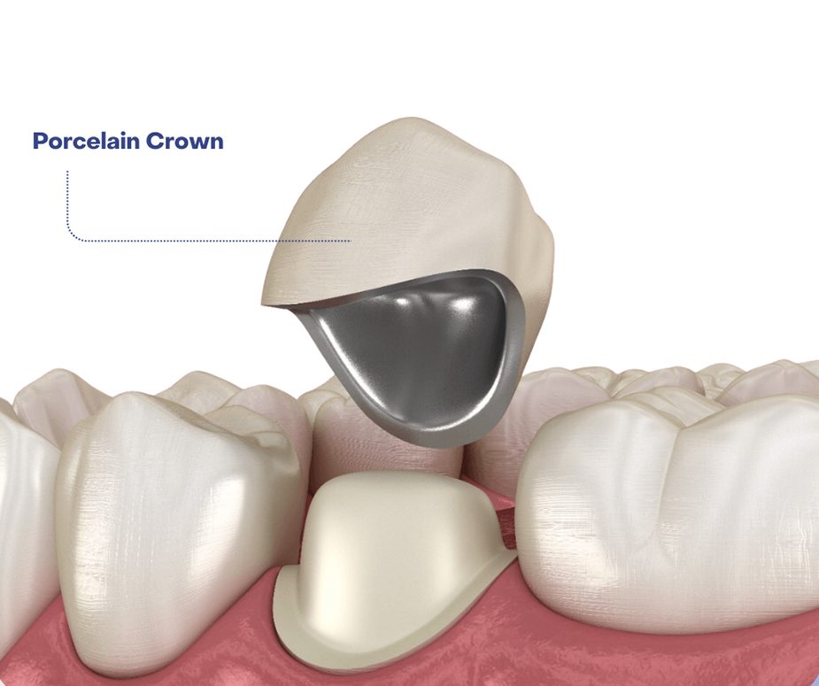 Porcelain Crown