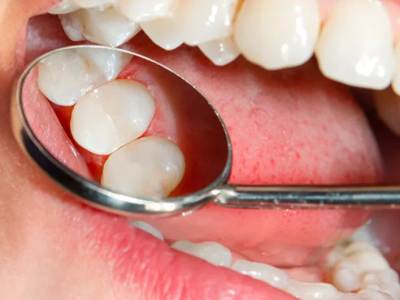 Dental Sealants Dental Sealants