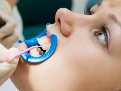 Fluoride Treatments fluoride treatments