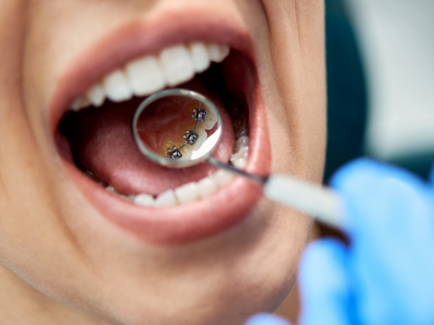 Lingual Braces